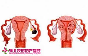 什么是子宫内膜异位症