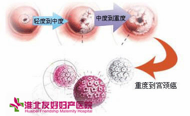 宫颈糜烂是哪些原因造成的